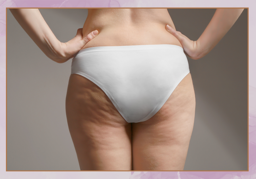 what causes cellulite