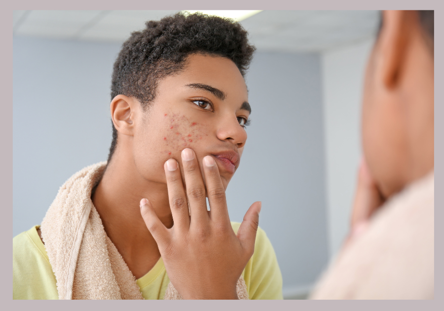 how to treat acne in adult men